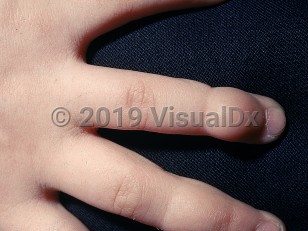 Clinical image of Ainhum - imageId=532333. Click to open in gallery.  caption: 'A deep, soft tissue groove with a distal bulbous enlargement on the ring finger, and earlier, less marked similar changes on the middle finger.'