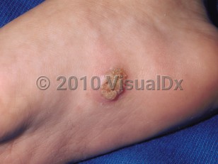 Clinical image of Plantar wart