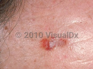 Clinical image of Nodular amyloidosis - imageId=538039. Click to open in gallery.  caption: 'A purpuric plaque with a scarred area on the forehead.'