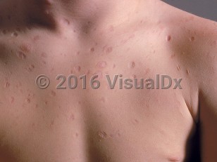 Clinical image of Atrophoderma - imageId=538949. Click to open in gallery.  caption: 'Many atrophic, depressed, and wrinkled papules and small plaques on the chest.'