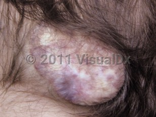 Clinical image of Meningocele - imageId=5405916. Click to open in gallery. 