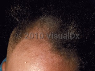 Clinical image of Menkes syndrome - imageId=54115. Click to open in gallery.  caption: 'Short, twisted hairs on the anterior scalp.'