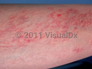 Clinical image of Angioma serpiginosum - imageId=541631. Click to open in gallery.  caption: 'Multiple erythematous and telangiectatic macules, papules and plaques on the lower leg.'