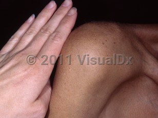 Clinical image of Hemochromatosis - imageId=5420735. Click to open in gallery.  caption: 'Diffuse bronze discoloration of the skin.'