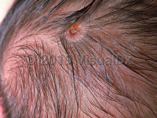 Clinical image of Aplasia cutis congenita