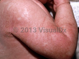 Clinical image of Multiple carboxylase deficiency