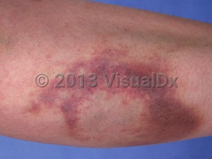 Clinical image of Autoerythrocyte sensitization - imageId=546204. Click to open in gallery.  caption: 'A large ecchymotic plaque on the leg.'