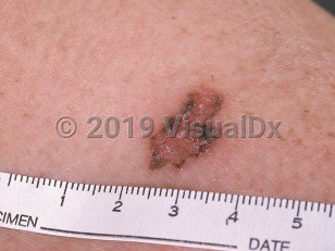 Clinical image of Pigmented basal cell carcinoma - imageId=547363. Click to open in gallery.  caption: 'A close-up of a pink plaque with overlying scale and brown and gray borders.'
