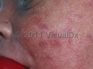 Clinical image of Cutaneous extramedullary hematopoiesis - imageId=5499647. Click to open in gallery.  caption: 'Many violaceous macules and thin papules on the cheek and nose. Note the unrelated tiny pustules of erythema toxicum neonatorum.'