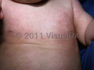 Clinical image of Roseola