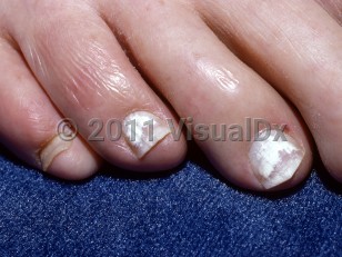 Clinical image of Superficial onychomycosis - imageId=5516446. Click to open in gallery.  caption: 'Bright white patches on the toenails.'
