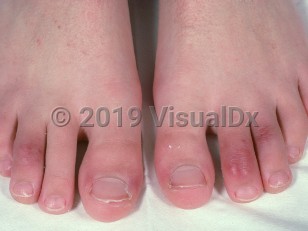 Clinical image of Chilblains - imageId=553919. Click to open in gallery.  caption: 'Erythematous, edematous papules and plaques on the toes.'