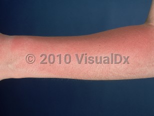 Clinical image of Sunburn - imageId=556579. Click to open in gallery.  caption: 'Bright pink erythema on the forearm.'