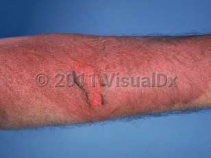 Clinical image of Thermal or electrical burn