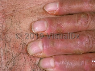 Clinical image of Acrokeratosis paraneoplastica - imageId=557055. Click to open in gallery.  caption: 'Hyperkeratotic papules and plaques involving the dorsal surface of the digits.'