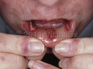 Clinical image of Pyostomatitis vegetans - imageId=5599600. Click to open in gallery.  caption: 'Large oral erosions, periungual erythema, and patchy erythema on the face.'