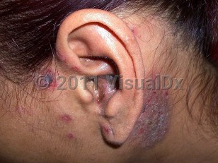 Clinical image of Kikuchi-Fujimoto disease - imageId=5618467. Click to open in gallery.  caption: 'Crusted and scaly papules and plaques in and around the ear.'