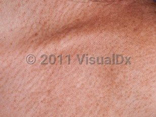Clinical image of Macular amyloidosis - imageId=5623260. Click to open in gallery.  caption: 'A close-up of confluent light brown macules forming a patch with a faint rippled appearance on the upper chest.'
