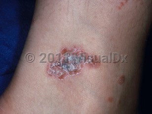 Clinical image of Tattoo reaction