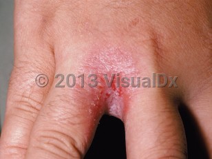 Clinical image of Candidiasis - imageId=56576. Click to open in gallery.  caption: 'Erosio interdigitalis blastomycetica showing a macerated and eroded plaque at the finger web.'
