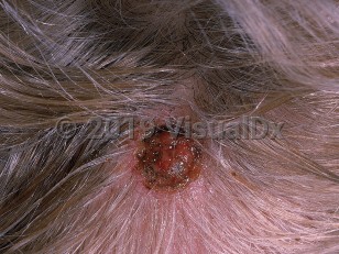 Clinical image of Cylindroma - imageId=566129. Click to open in gallery.  caption: 'A crusted nodule on the scalp.'