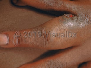 Clinical image of Blistering distal dactylitis - imageId=568830. Click to open in gallery.  caption: 'Marked edema of the proximal finger with a deroofed bulla.'