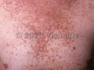 Clinical image of Darier disease - imageId=570062. Click to open in gallery.  caption: 'Hundreds of confluent, reddish-brown, scaly papules forming plaques on the upper chest.'