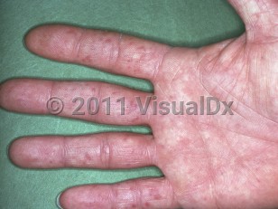 Clinical image of Cold agglutinin disease