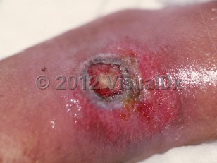 Clinical image of Aspergillosis - imageId=57023. Click to open in gallery.  caption: 'An ulcer with a gray border and a surrounding pink plaque on the forearm.'