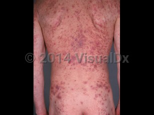 Clinical image of Chloracne - imageId=571261. Click to open in gallery. 
