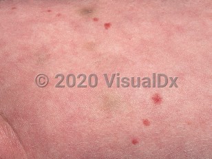 Clinical image of Hermansky-Pudlak syndrome - imageId=572638. Click to open in gallery.  caption: 'Pink papules (nevi), ecchymoses, and background dilution of skin color on the chest.'