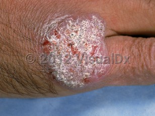 Clinical image of Chromoblastomycosis - imageId=573021. Click to open in gallery.  caption: 'A thickly scaly and crusted pink plaque on the dorsal hand.'