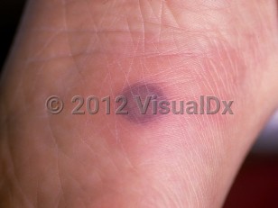 Clinical image of Disseminated Fusarium infection - imageId=57327. Click to open in gallery.  caption: 'A deep-seated, violaceous plaque with surrounding erythema on the sole.'
