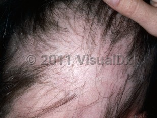 Clinical image of Thyroiditis - imageId=5756407. Click to open in gallery.  caption: 'Alopecia areata in <span>thyroiditis. </span>'