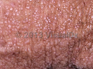 Clinical image of Colloid milium - imageId=5766196. Click to open in gallery. 
