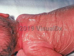 Clinical image of Collodion baby - imageId=579365. Click to open in gallery.  caption: 'Diffuse erythema with overlying shiny, wrinkled, membrane-like plaques on the scalp, neck, back, and arms.'