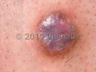 Clinical image of Dermatofibroma - imageId=580299. Click to open in gallery.  caption: 'A close-up of a violaceous papule with a light brown rim.'