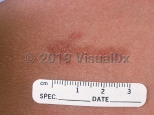 Clinical image of Caterpillar dermatitis - imageId=585727. Click to open in gallery.  caption: 'A close-up of a patterned, red-brown, slightly scaly plaque on the flank.'