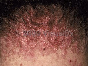 Clinical image of Acne keloidalis nuchae - imageId=58803. Click to open in gallery.  caption: 'Myriads of smooth, tiny, pink papules at the occipital scalp and posterior neck.'