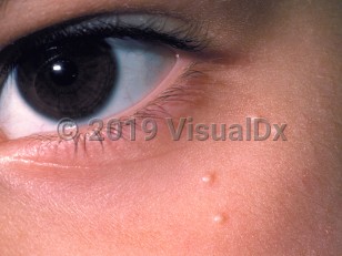 Clinical image of Milia - imageId=59031. Click to open in gallery.  caption: 'Few tiny, smooth, white papules near the eye.'