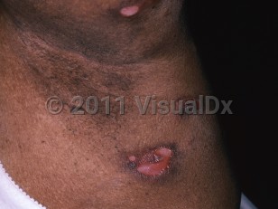 Clinical image of Lymphomatoid granulomatosis - imageId=5924209. Click to open in gallery.  caption: 'Superficial ulcers and an atrophic scar in the axilla.'