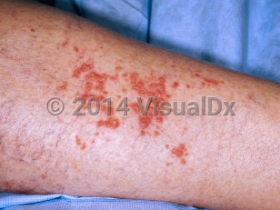 Clinical image of Warty dyskeratoma - imageId=5926976. Click to open in gallery.  caption: 'A large cluster of many discrete and confluent reddish papules, each with overlying thick scale, on the forearm.'