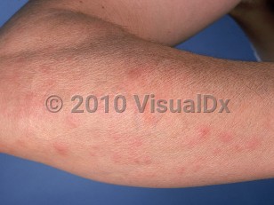 Clinical image of Autoimmune progesterone dermatitis - imageId=595447. Click to open in gallery.  caption: 'Faint erythematous papules and plaques on the forearm.'