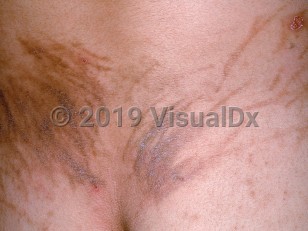 Clinical image of Drug-induced flagellate pigmentation - imageId=598666. Click to open in gallery.  caption: 'A close-up of flagellate brown plaques on the lower back, some scaly, following medication infusion.'