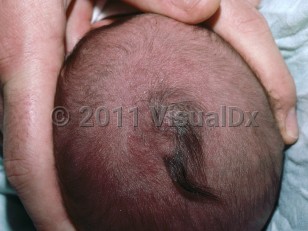 Clinical image of Encephalocele - imageId=5991371. Click to open in gallery.  caption: 'A hair collar sign (thicker terminal hair growth) around a patulous plaque on the scalp.'