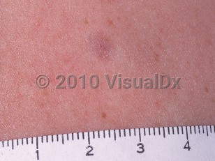 Clinical image of Eccrine spiradenoma - imageId=601200. Click to open in gallery.  caption: 'A close-up of a subtle violaceous papule.'