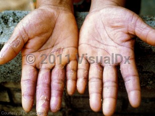 Clinical image of Trichinellosis - imageId=6021424. Click to open in gallery.  caption: 'Acute trichinellosis showing edematous digits and peeling, violaceous plaques on the palms and fingers.'