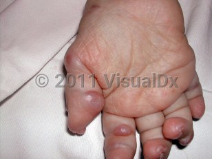 Clinical image of Hyaline fibromatosis syndrome - imageId=6022208. Click to open in gallery.  caption: 'Shiny reddish and somewhat translucent papules and nodules over the finger joints.'