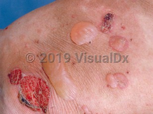 Clinical image of Epidermolysis bullosa acquisita