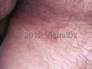 Clinical image of Tinea cruris - imageId=6035594. Click to open in gallery.  caption: 'An erythematous plaque with peripherally accentuated fine white scale on the upper inner thigh.'